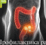 Профилактика рака прямой кишки - РЦМП